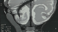Cervical Spinal Stenosis